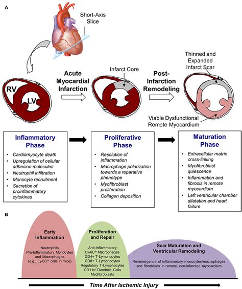 ventricular remodeling after myocardial infarction